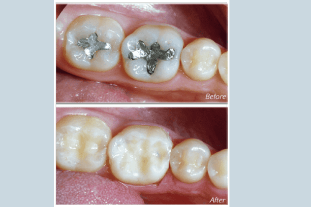 Dentist curing teeth of patient in clinic<br />
